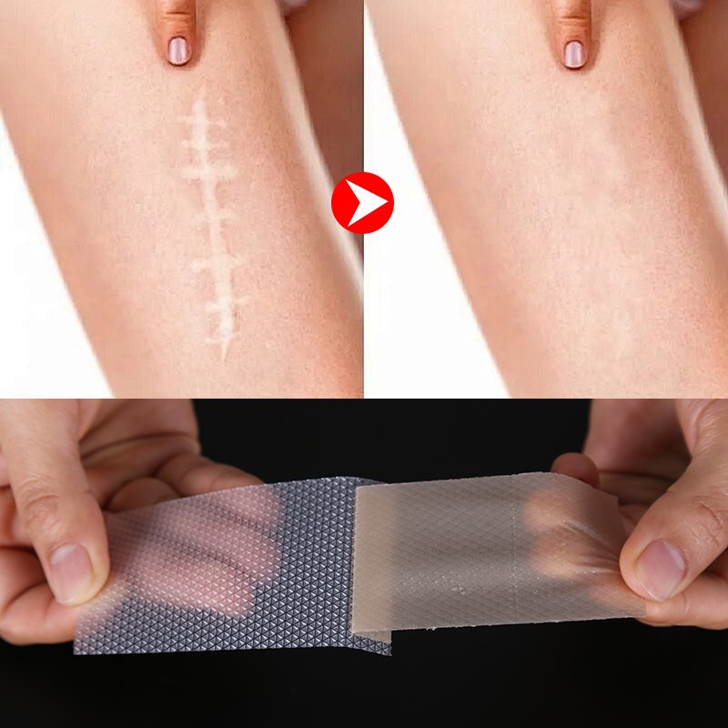 Cerotti e nastro in gel di silicone al collagene per le cicatrici - 12